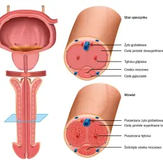 Anatomia penisa: przekroje w stanie spoczynku i wzwodu pokazują, że czy penis to mięsień, jest złożony z ciał jamistych i gąbczastych, naczyń krwionośnych i cewki moczowej.